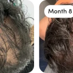 Topical Finasteride for Thicker, Long Hair