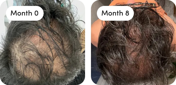 Topical Finasteride for Thicker, Long Hair